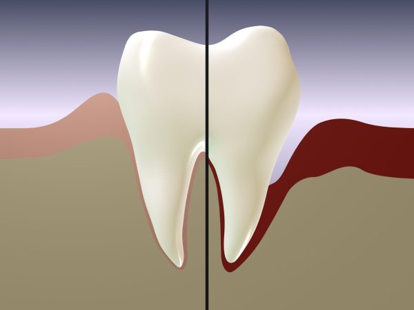 Periodontal,Disease.,Tooth,Split,In,Half.,?ontrast,Of,Irradiation,And